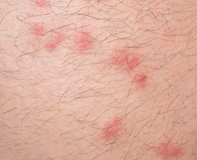 flea bites
